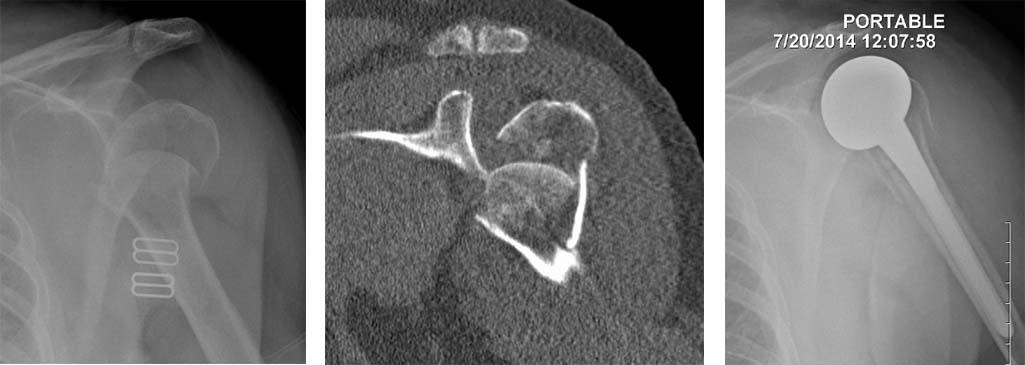 shoulder-arthroscopy