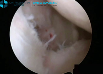 The Long Head of the Biceps Tendon Pathology: Treatment with Subpectoral Biceps Tenodesis