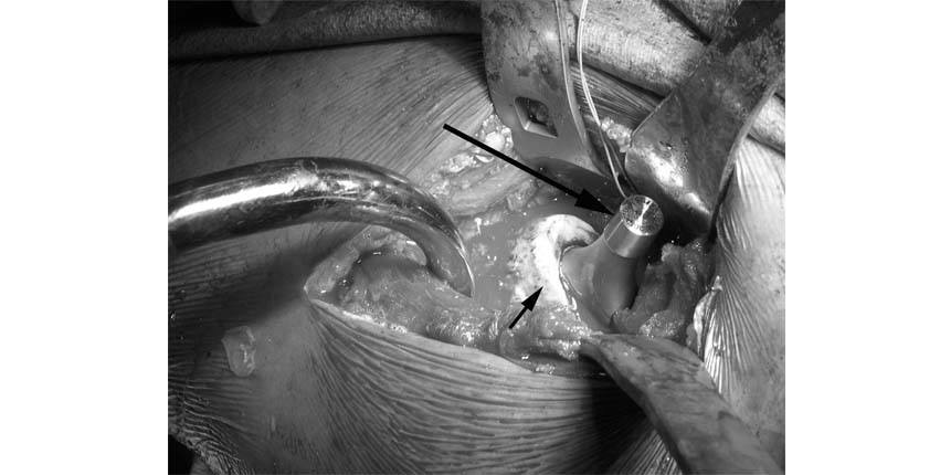 thr-anterior-approach