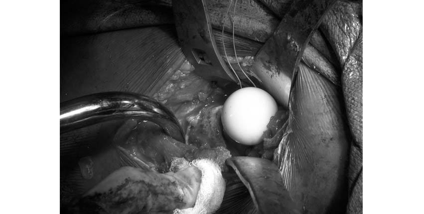 thr-anterior-approach