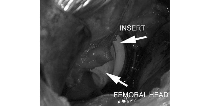 thr-anterior-approach