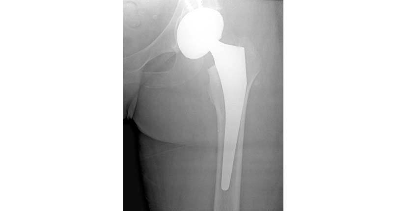 thr-anterior-approach