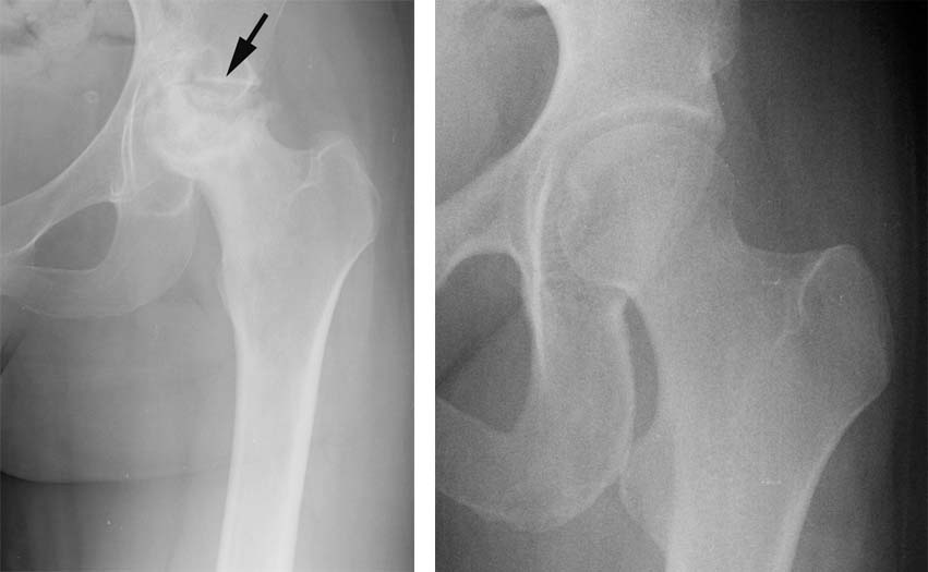 thr-anterior-approach