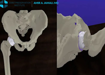 Three Dimensional Femoroacetabular Impingement Animation